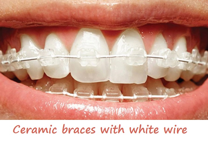 Ceramic braces with white wire