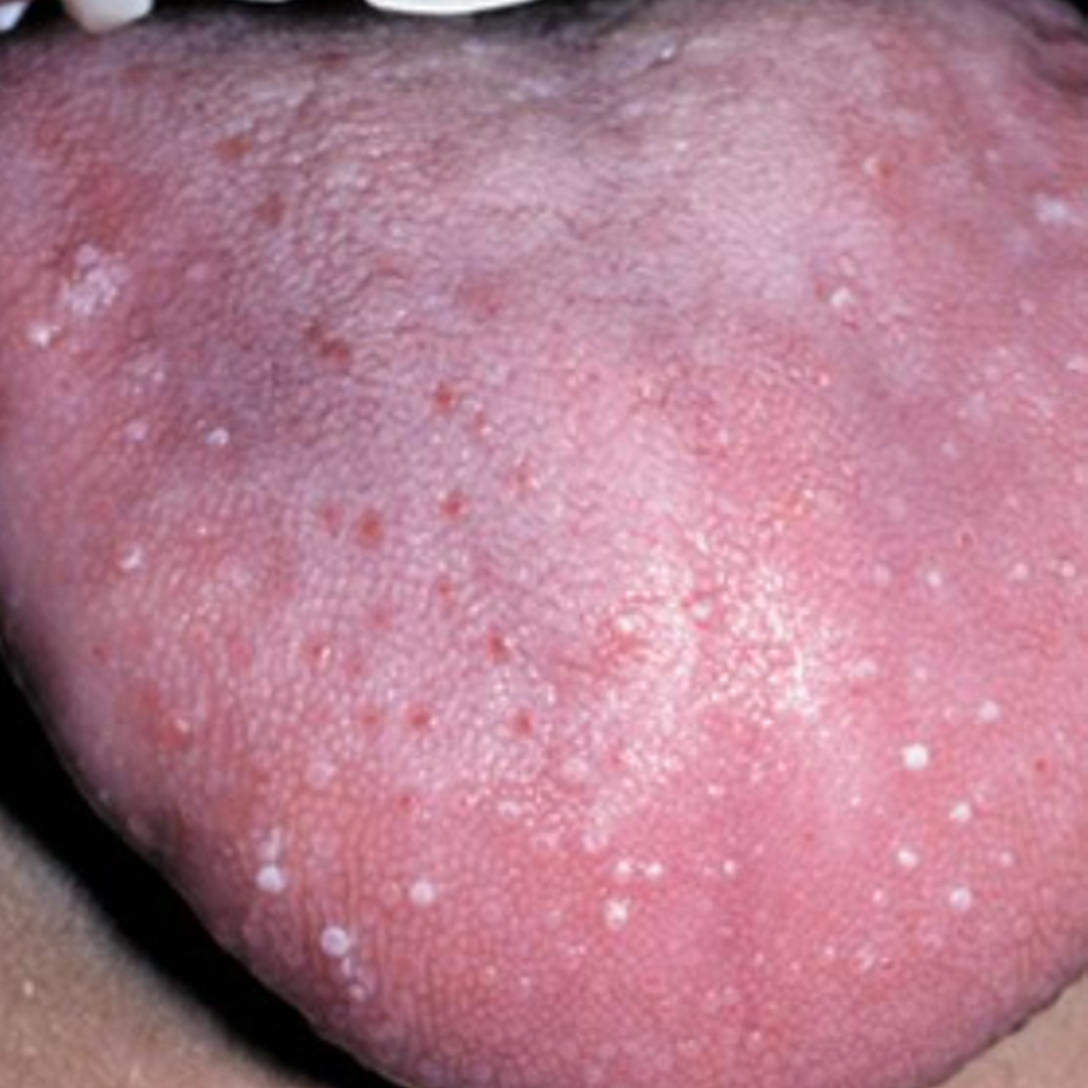 chlamydia bumps on tongue