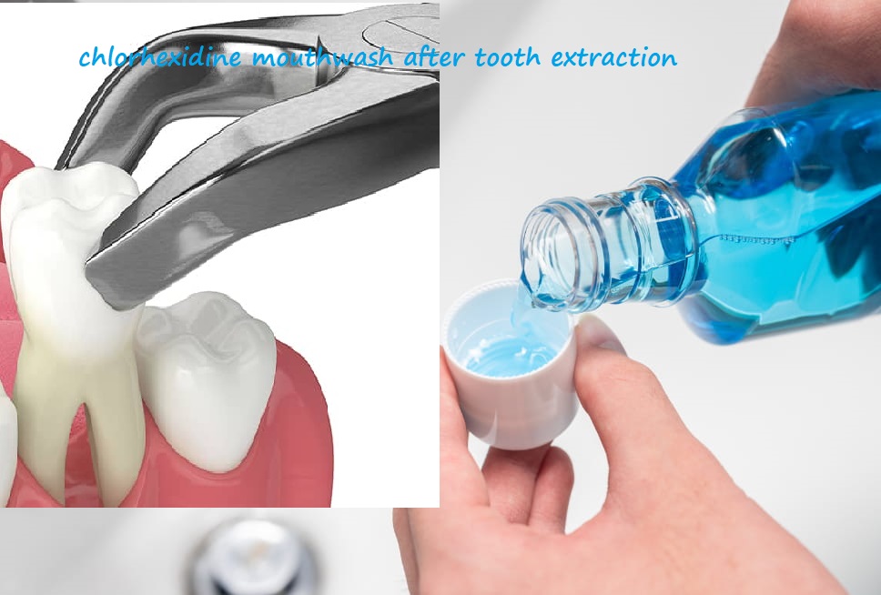 chlorhexidine mouthwash after tooth extraction