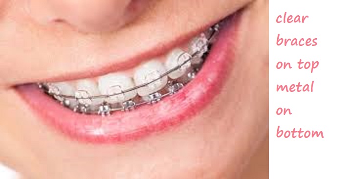 Clear braces on top metal on bottom