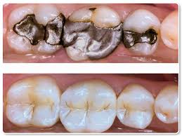 composite filling