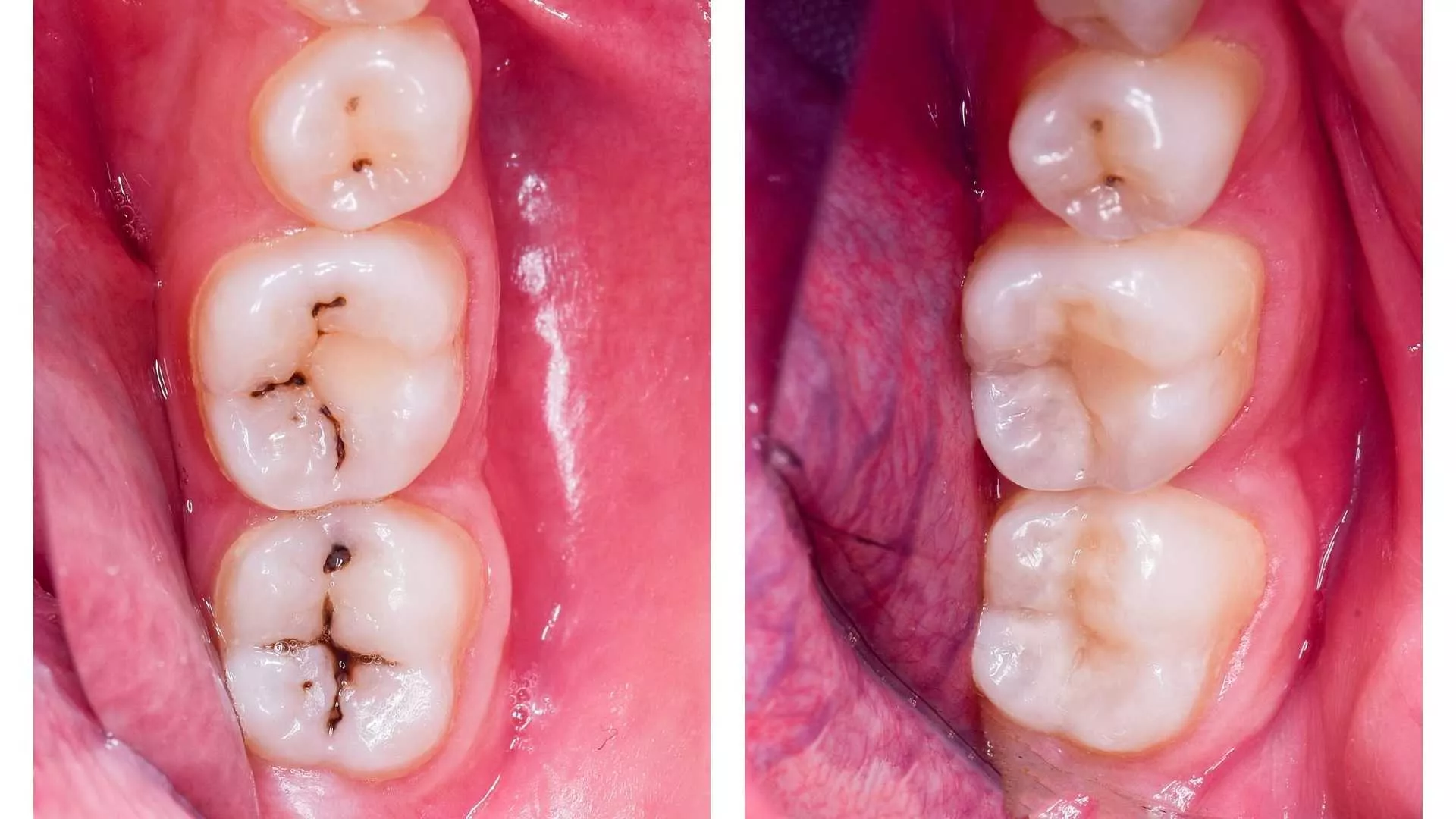 composite filling