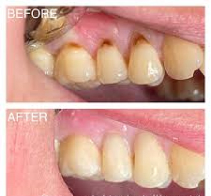 composite fillings for receding gums