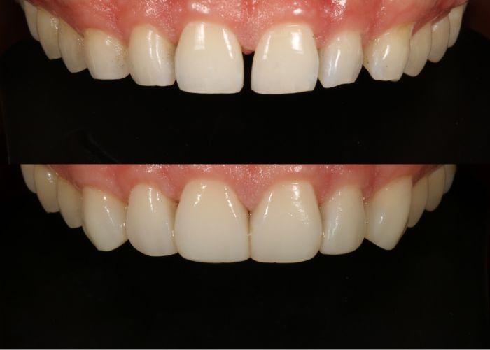 composite veneers