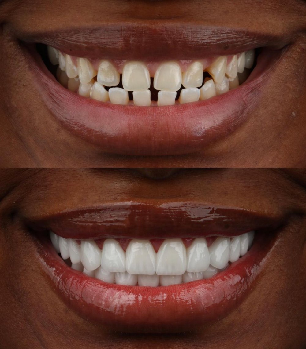 composite veneers