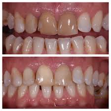 composite veneers