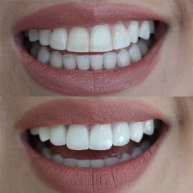 composite veneers