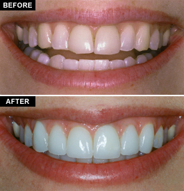 composite veneers vs porcelain veneers