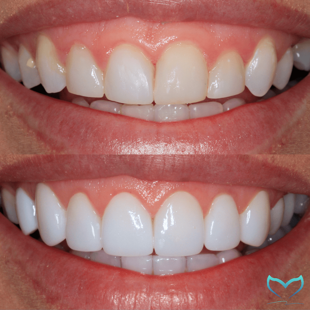 composite veneers vs porcelain veneers