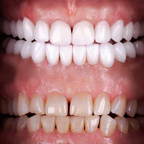 composite veneers vs porcelain veneers