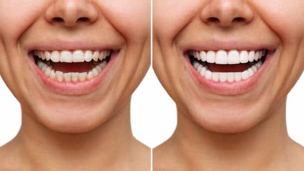 composite veneers vs porcelain veneers