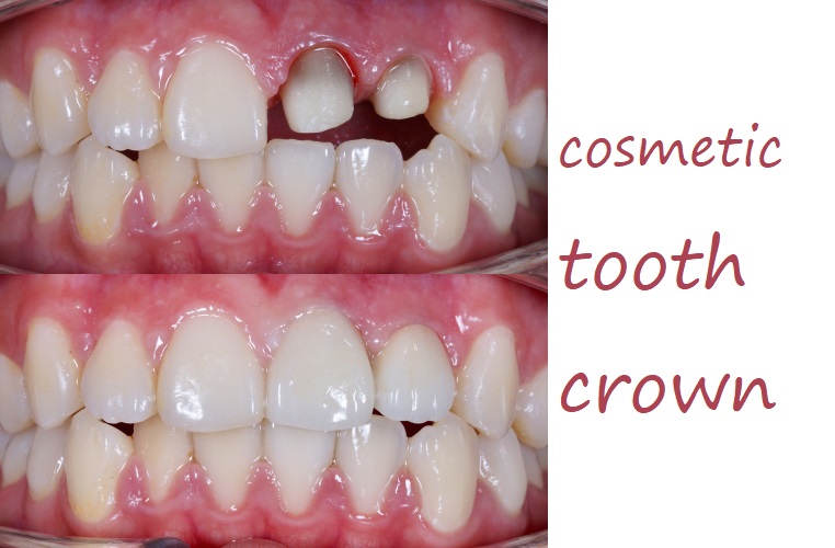 cosmetic tooth crown