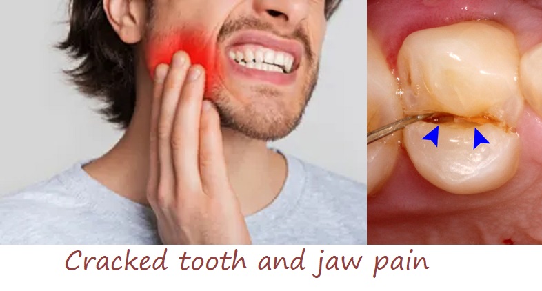 cracked tooth and jaw pain