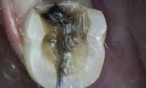 cracked tooth under crown