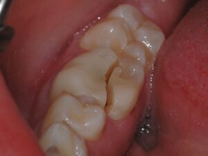 crown for cracked tooth