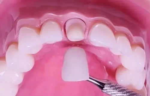 crown on front tooth