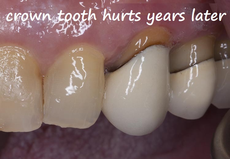 crown tooth hurts years later