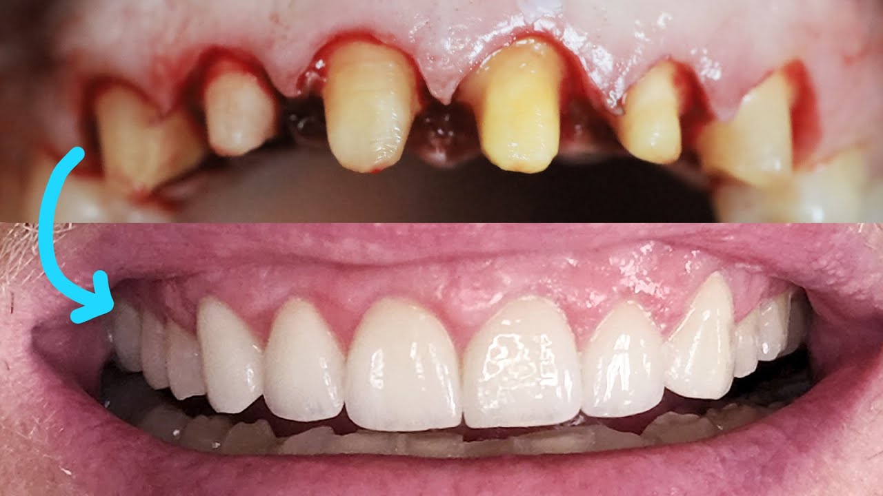 crowns on front teeth