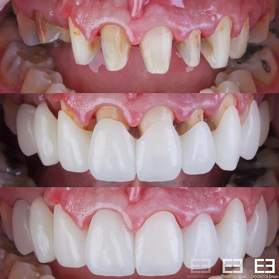 crowns on front teeth