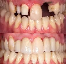 crowns on front teeth