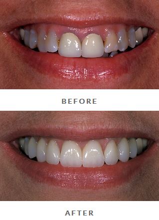 crowns on front teeth