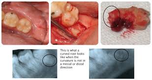 curved root tooth extraction pain