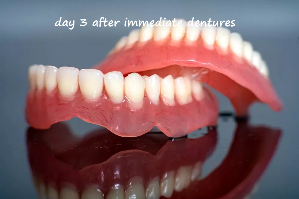 day 3 after immediate dentures