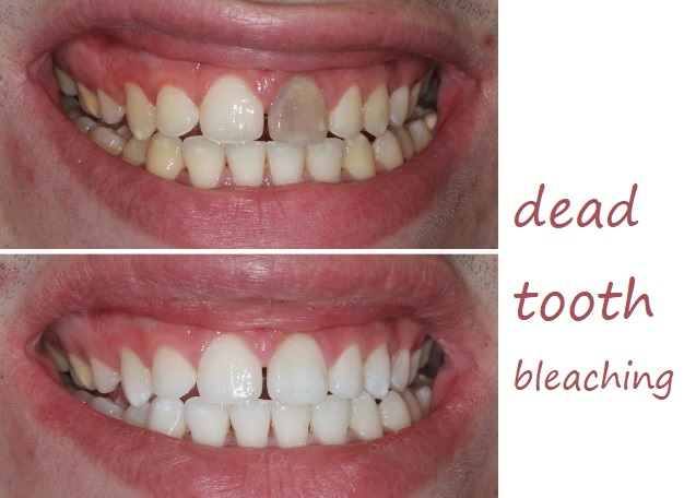 dead tooth bleaching