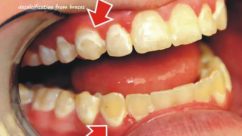 Decalcification from braces