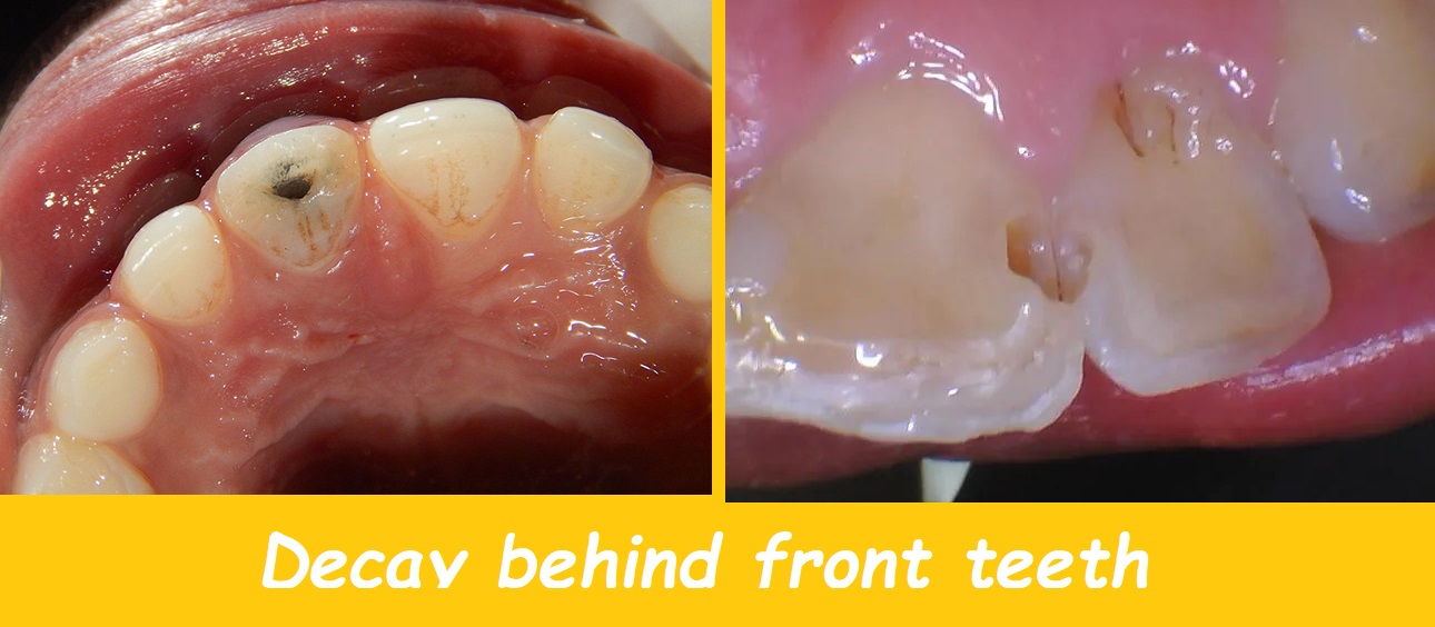 decay behind front teeth