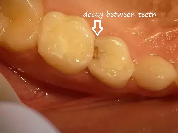 decay between teeth