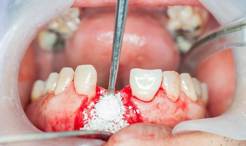 dental bone graft healing stages