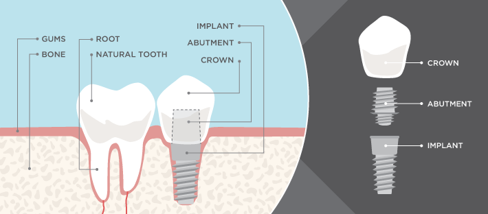 dental implant anatomy