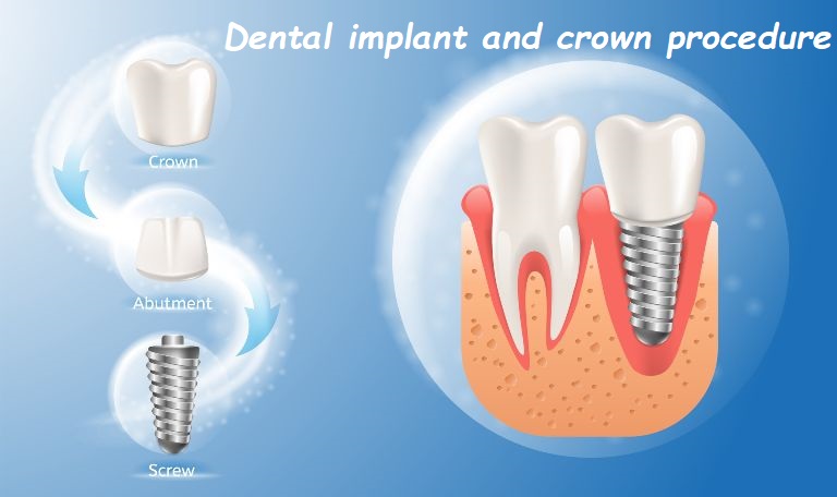 dental implant and crown procedure