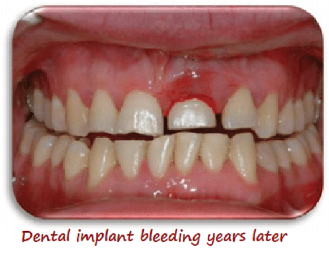 Dental implant bleeding years later