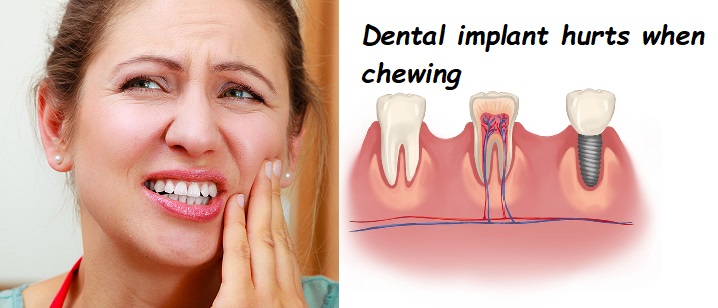 Dental implant hurts when chewing