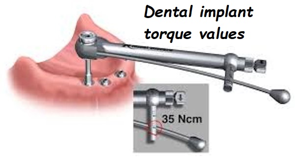 Dental implant torque values