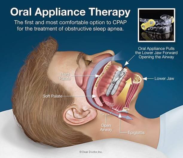 Dental implants for sleep apnea