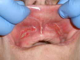 how long do denture sores take to heal