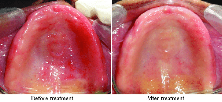denture stomatitis treatment
