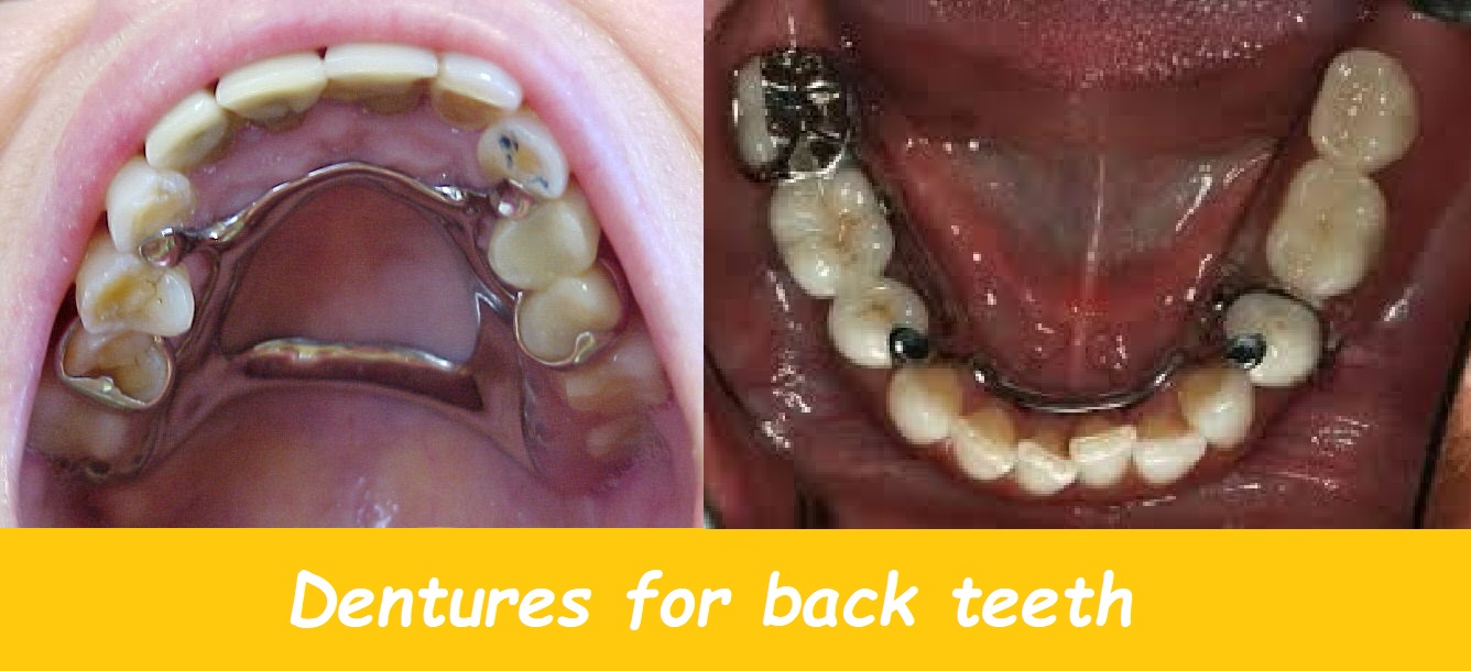 dentures for back teeth