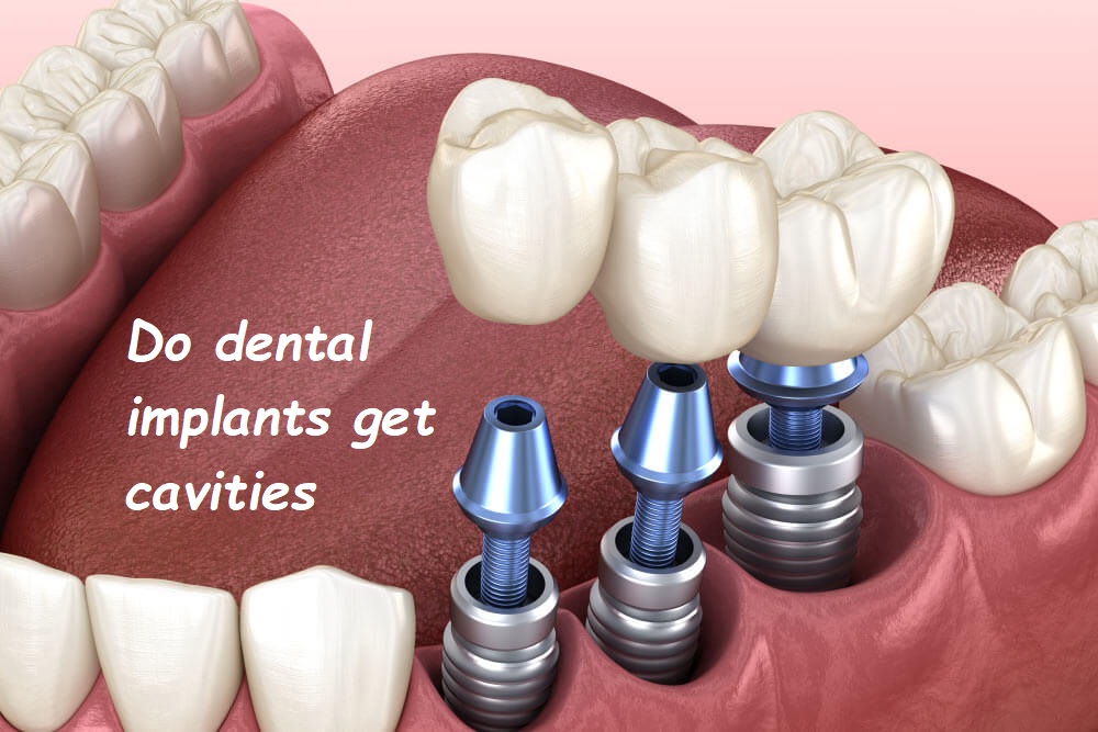 Do dental implants get cavities