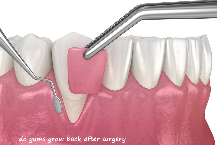 do gums grow back after surgery