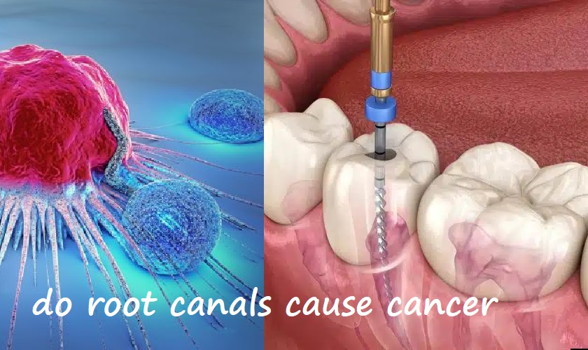 do root canals cause cancer