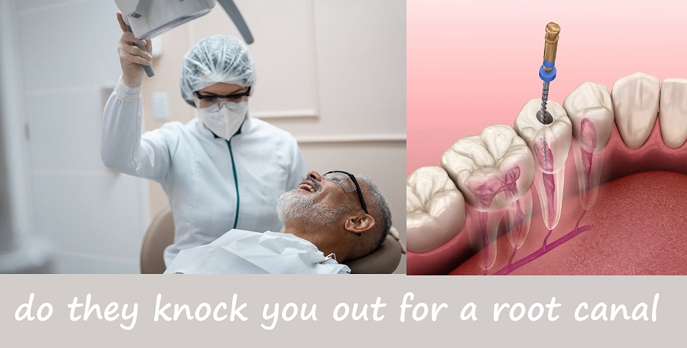 do they knock you out for a root canal