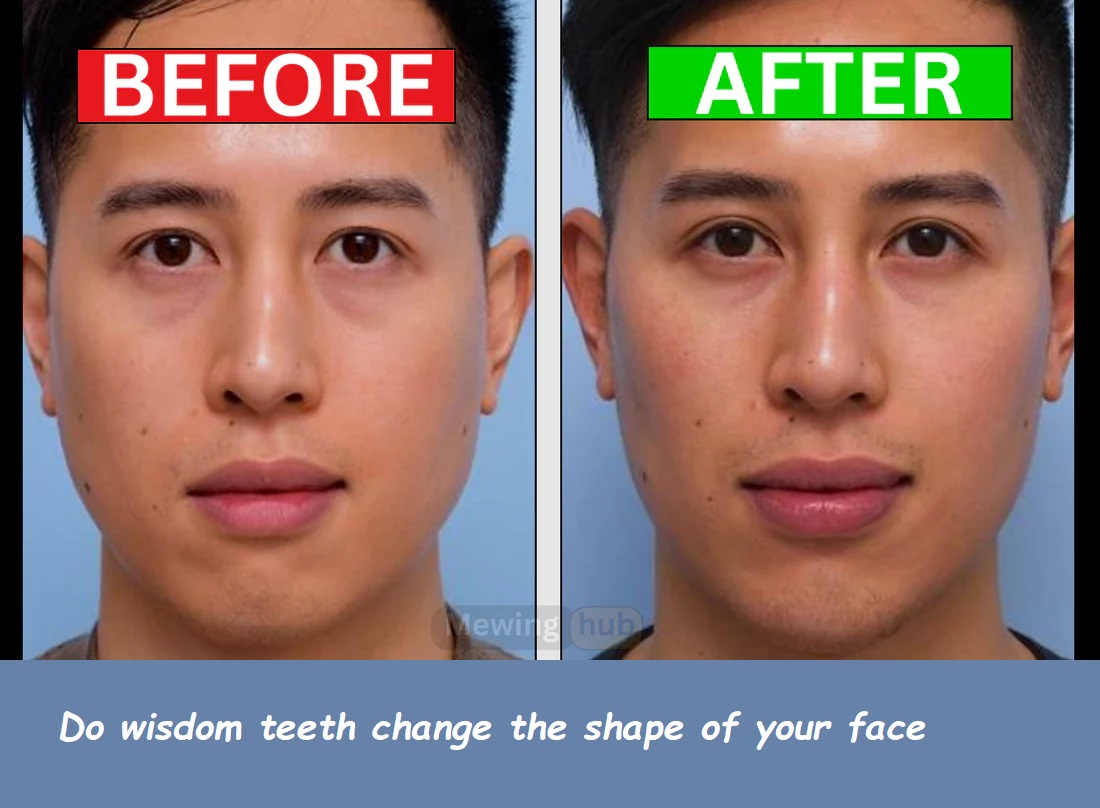 do wisdom teeth change the shape of your face