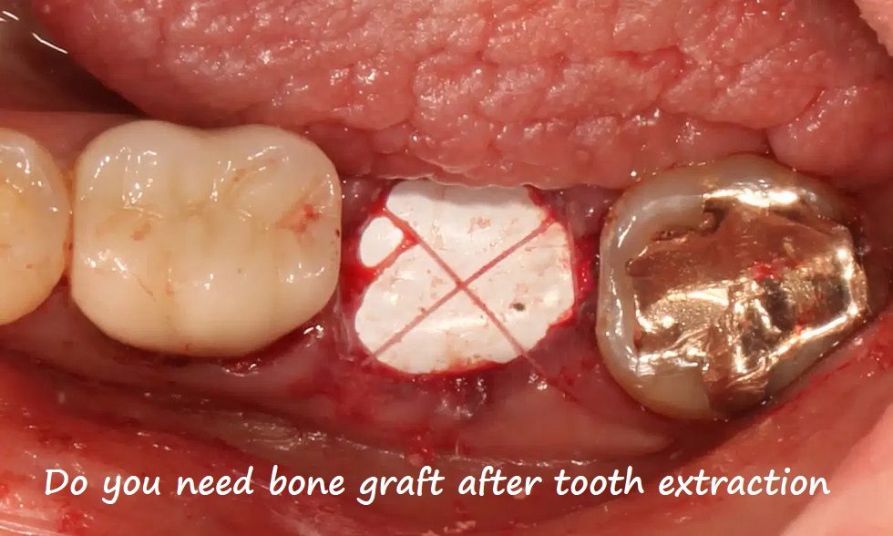 do you need bone graft after tooth extraction