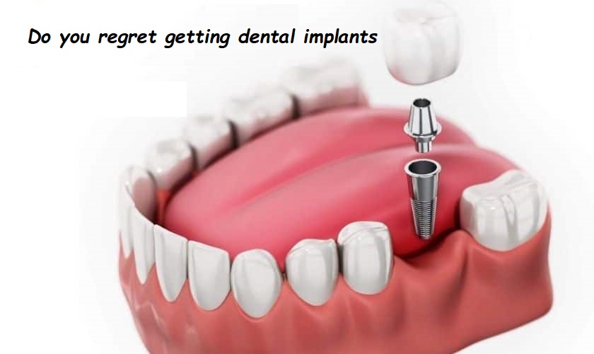 Do you regret getting dental implants