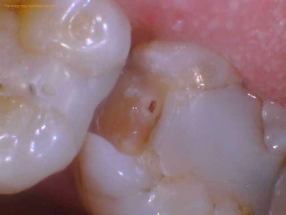 Exposed Tooth Nerve