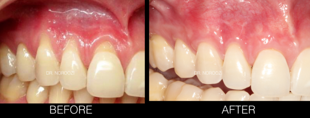 exposed tooth root